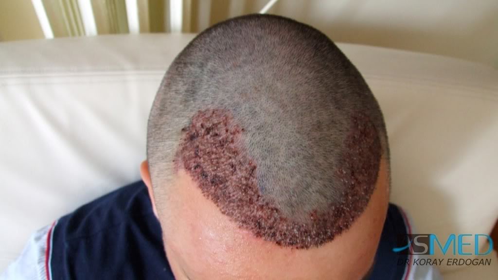 Before and After  graft    transplant at 