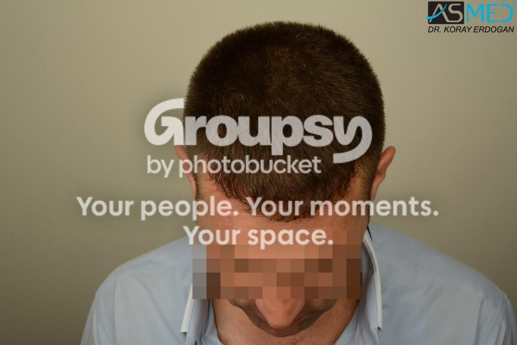 FUE Hair Transplant Result
