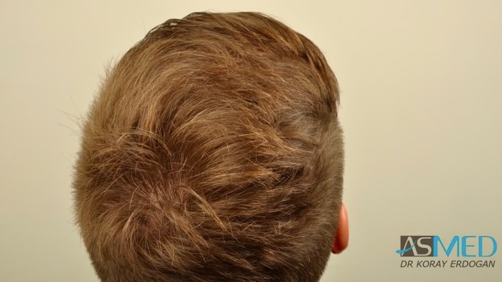 Before and After  graft    transplant at 