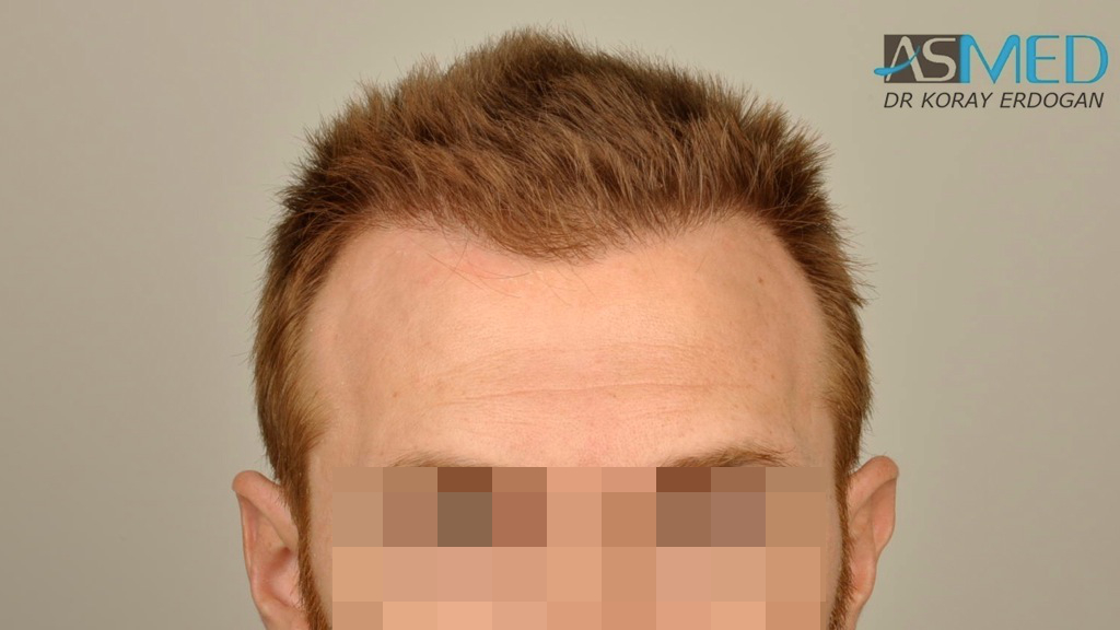 FUE Hair Transplant Result