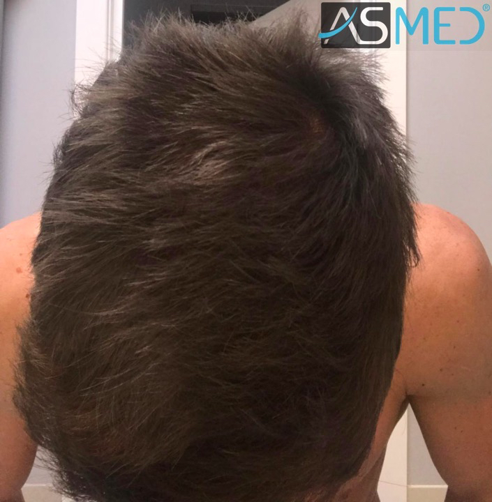 Before and After  graft    transplant at 