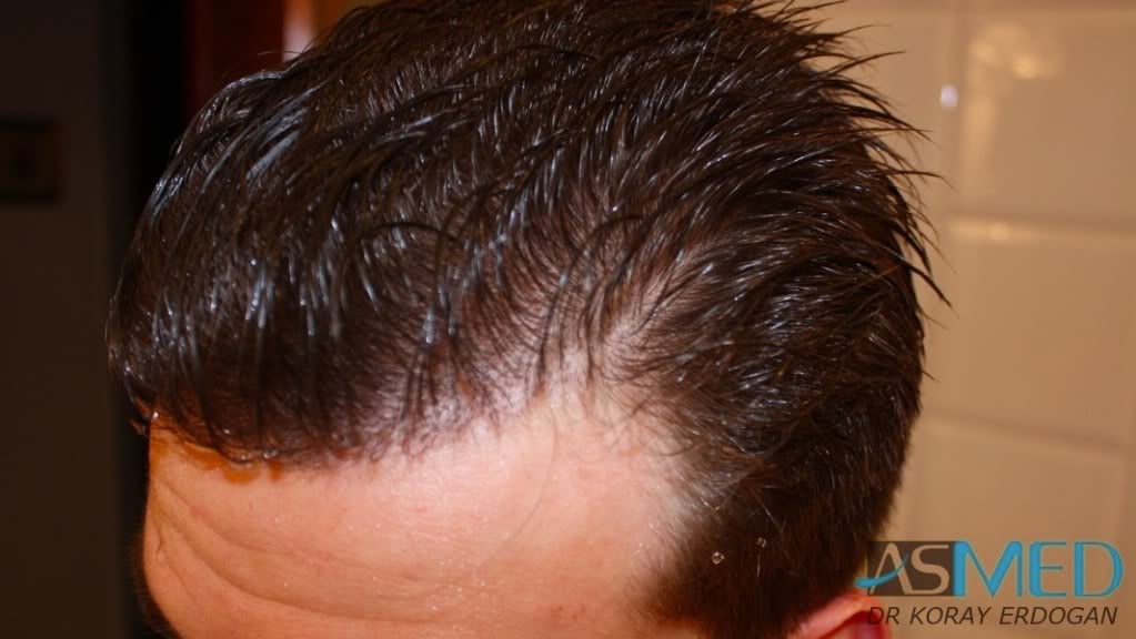 Before and After  graft    transplant at 