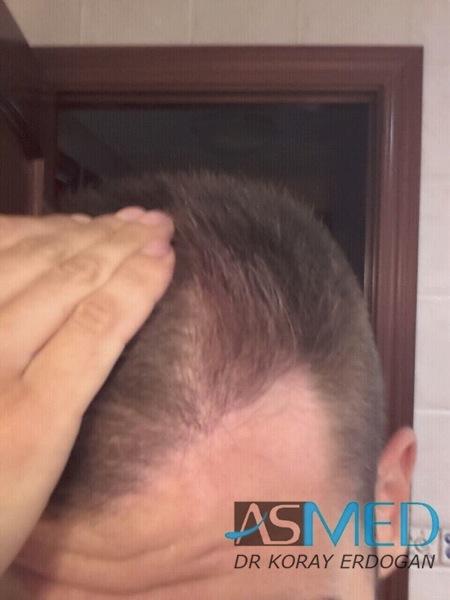 Before and After  graft    transplant at 