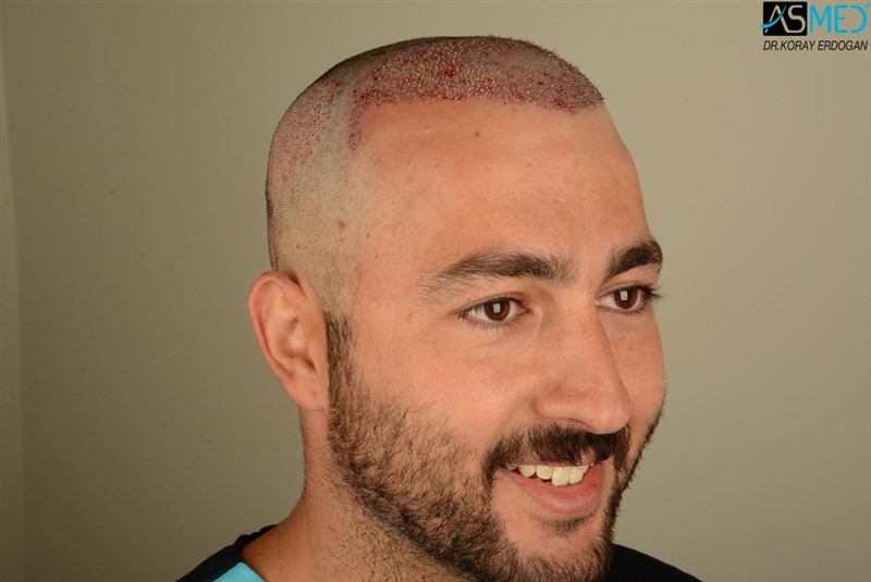 Before and After  graft    transplant at 