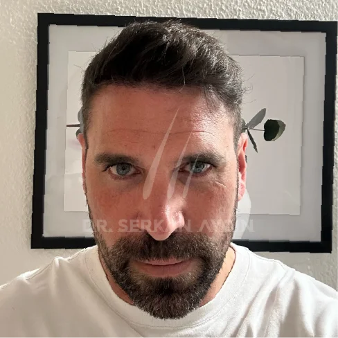 DHI Hair Transplant Result