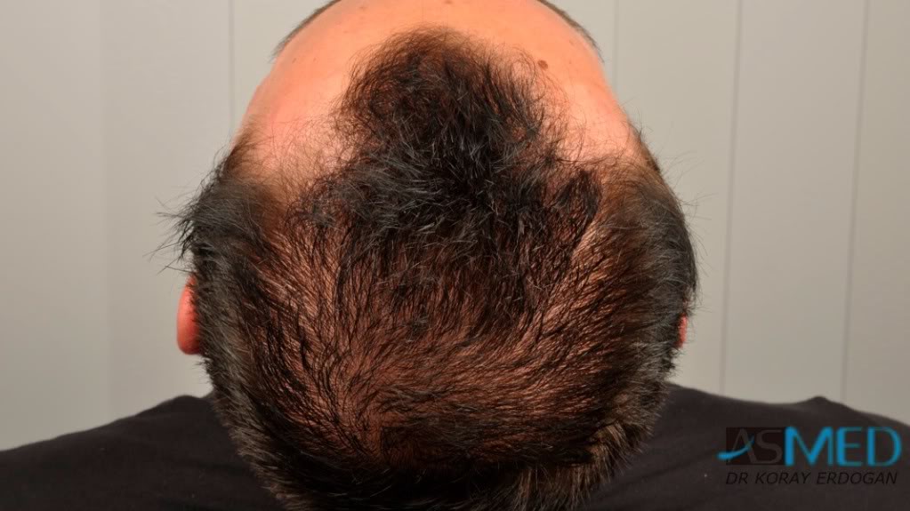 Before and After  graft    transplant at 