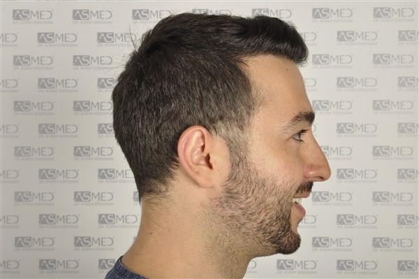 Before and After  graft    transplant at 