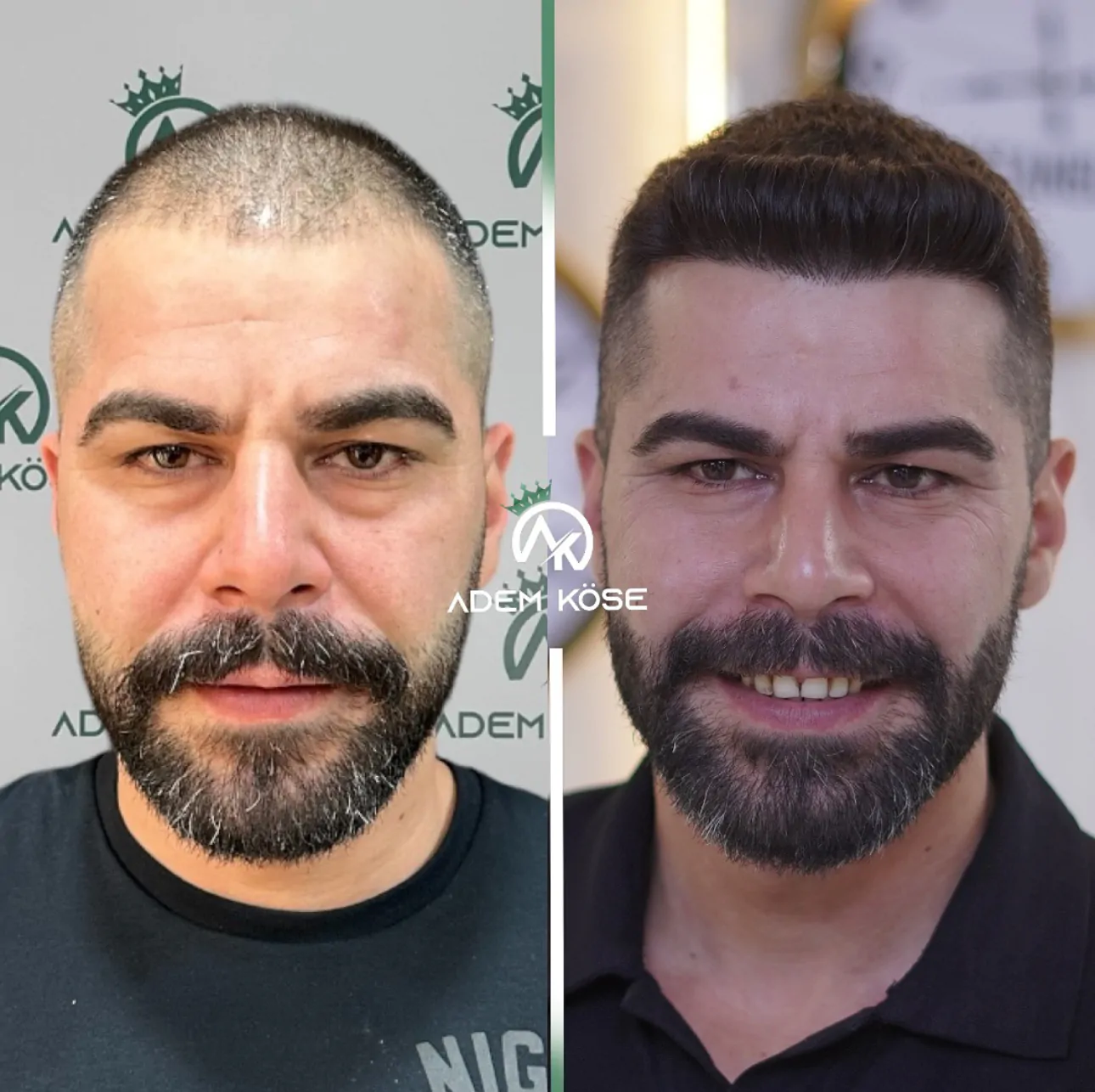 FUE Hair Transplant Result