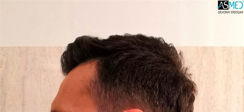 Before and After  graft    transplant at 