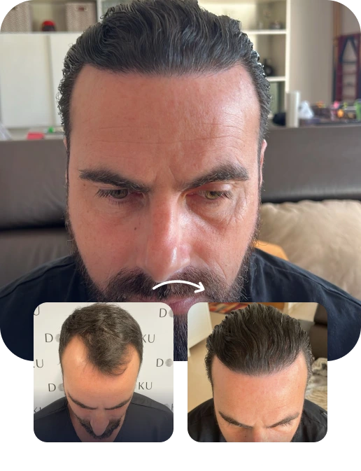DHI Hair Transplant Result