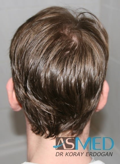 FUE Hair Transplant Result