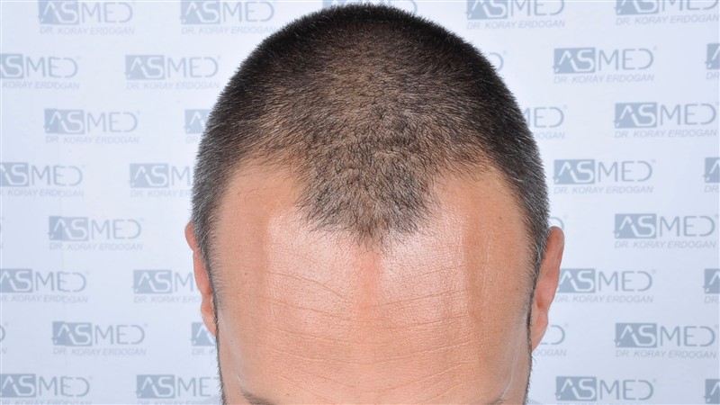 Before and After  graft    transplant at 
