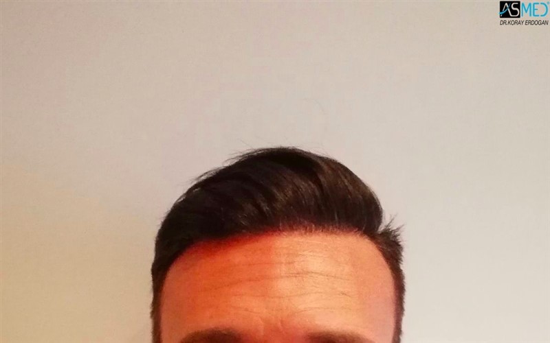 Before and After 3006 graft  FUE hair transplant at ASMED Medical Center