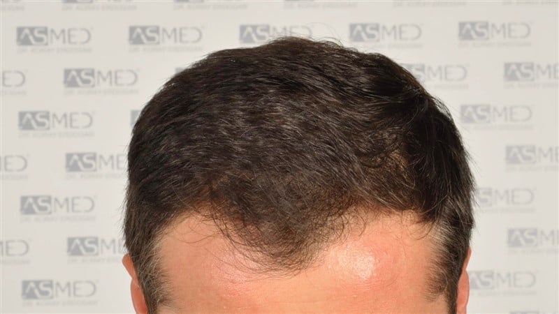 Before and After  graft    transplant at 