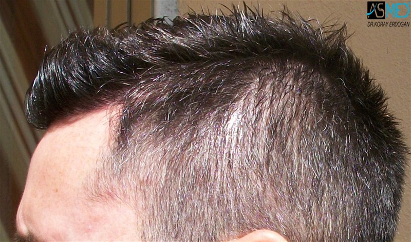 Before and After  graft    transplant at 