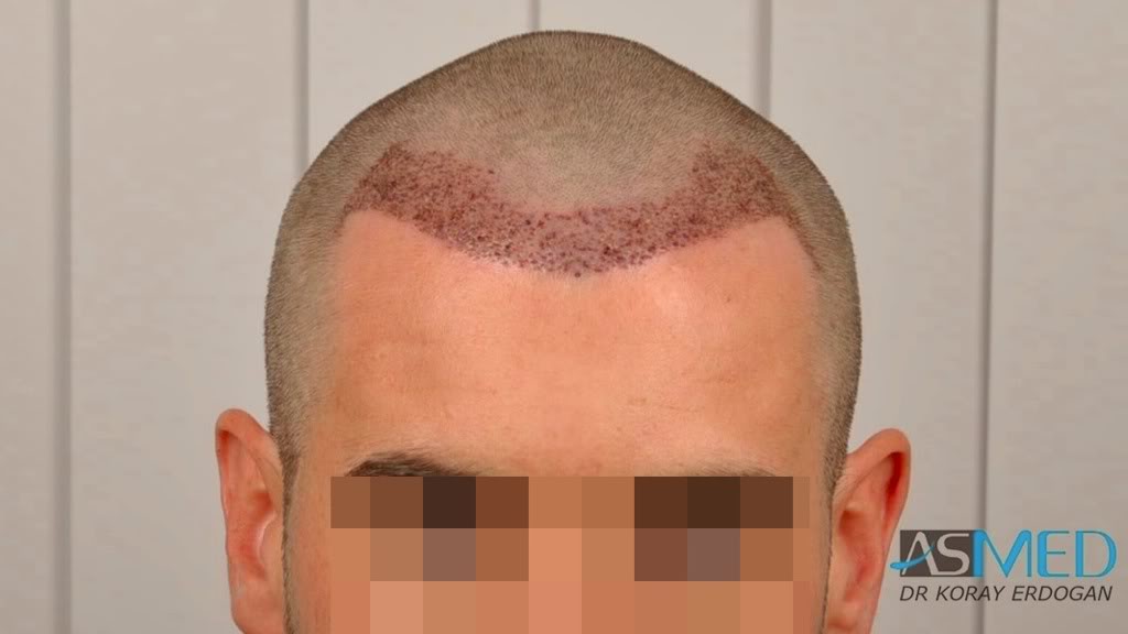 Before and After  graft    transplant at 