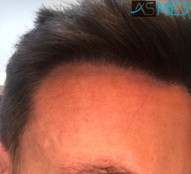 Before and After  graft    transplant at 