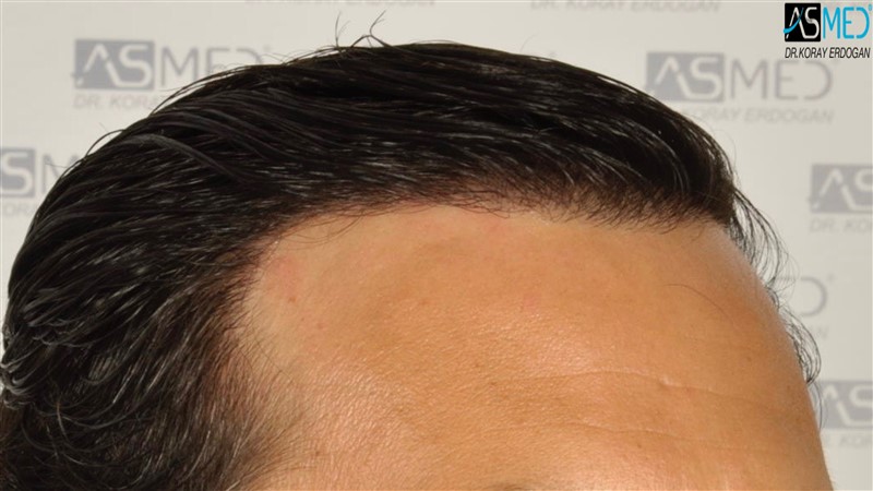 Before and After  graft    transplant at 