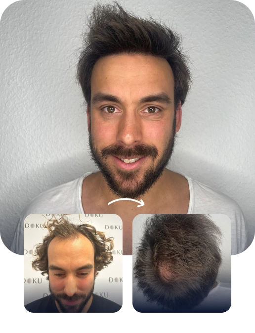 DHI Hair Transplant Result