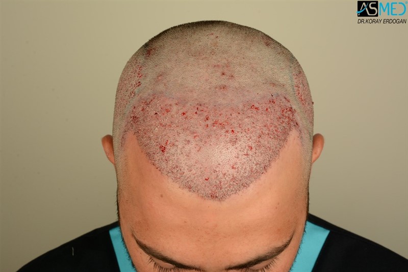 Before and After  graft    transplant at 