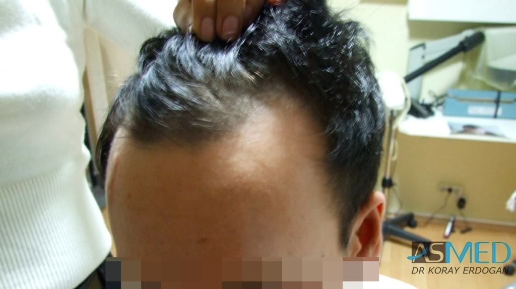 Before and After  graft    transplant at 