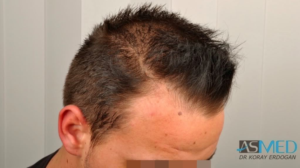 Before and After  graft    transplant at 