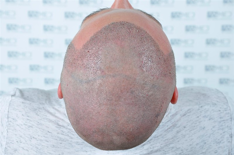 Before and After  graft    transplant at 