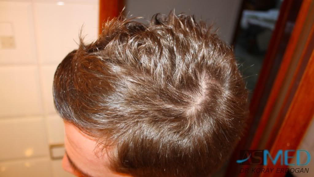 Before and After  graft    transplant at 