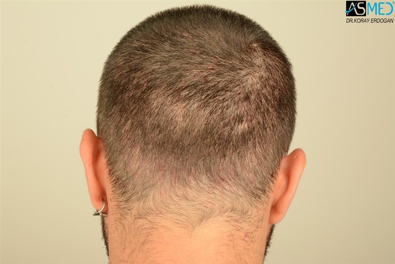 Before and After  graft    transplant at 