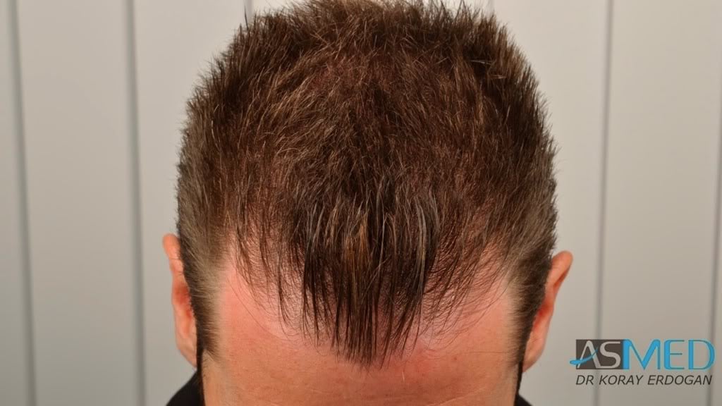 Before and After  graft    transplant at 