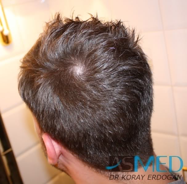 Before and After  graft    transplant at 