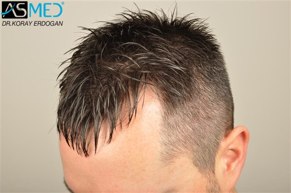 Before and After  graft    transplant at 