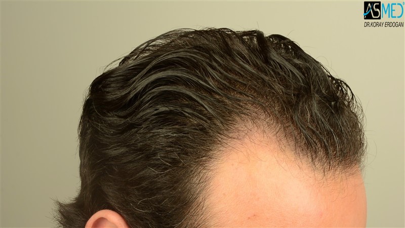 Before and After  graft    transplant at 