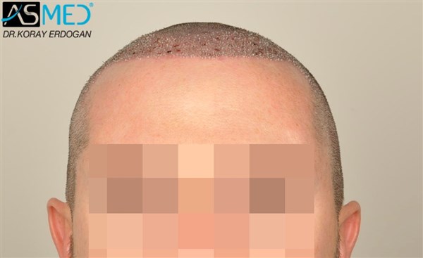 Before and After  graft    transplant at 