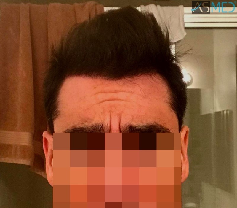 FUE Hair Transplant Result