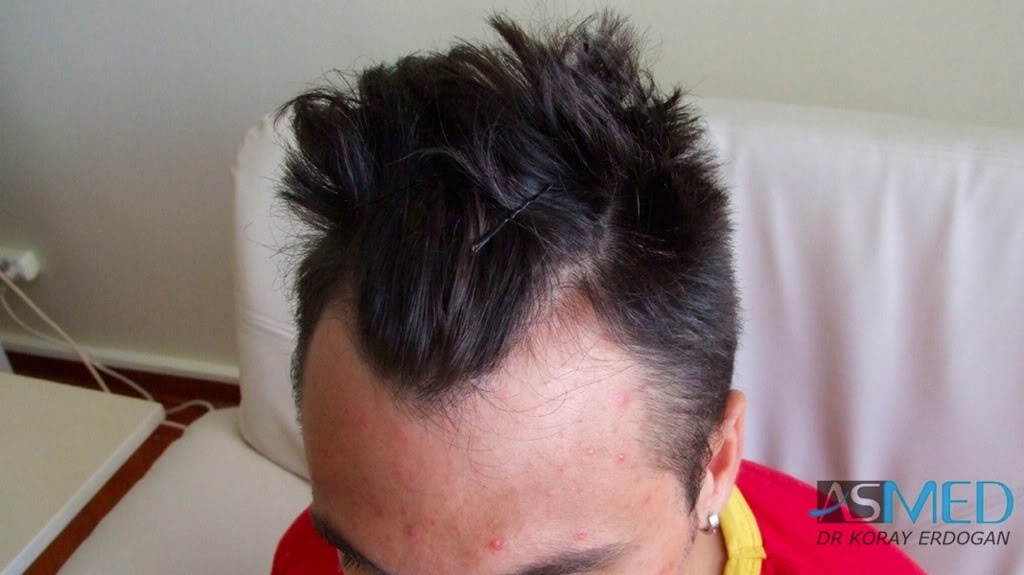 Before and After  graft    transplant at 
