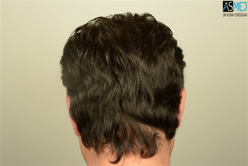 Before and After  graft    transplant at 
