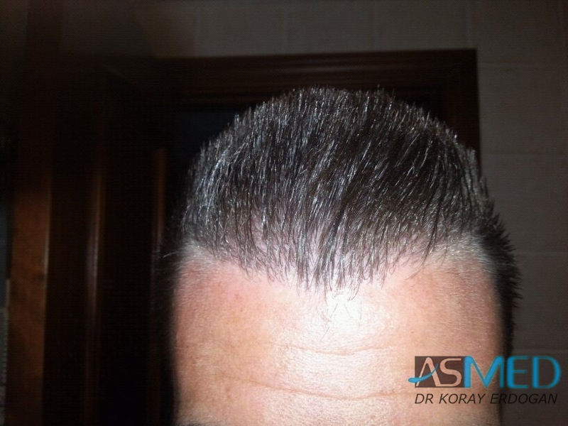 Before and After 1113 graft  FUE hair transplant at ASMED Medical Center