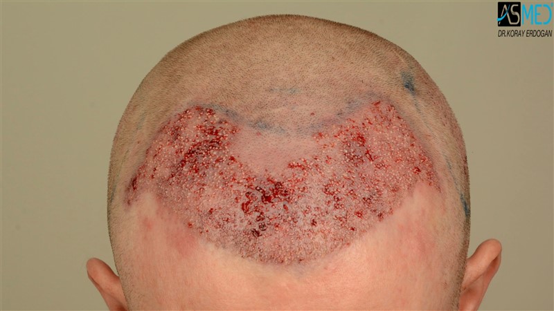 Before and After  graft    transplant at 