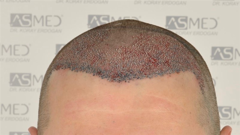 Before and After  graft    transplant at 