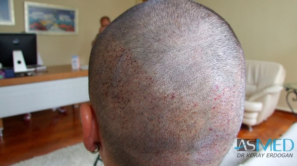 Before and After  graft    transplant at 