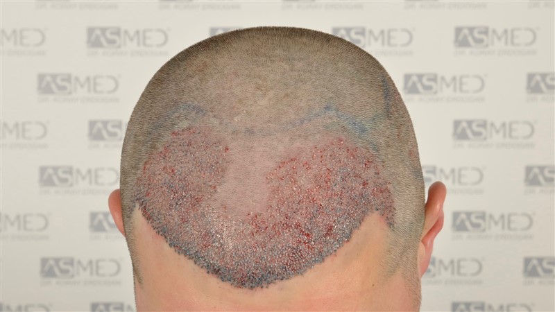 Before and After  graft    transplant at 