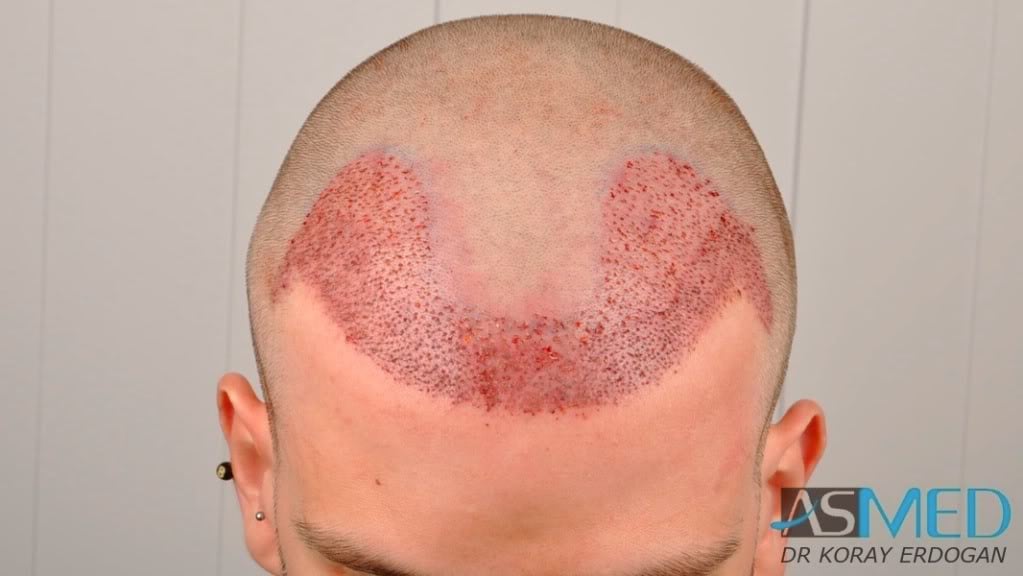 Before and After  graft    transplant at 
