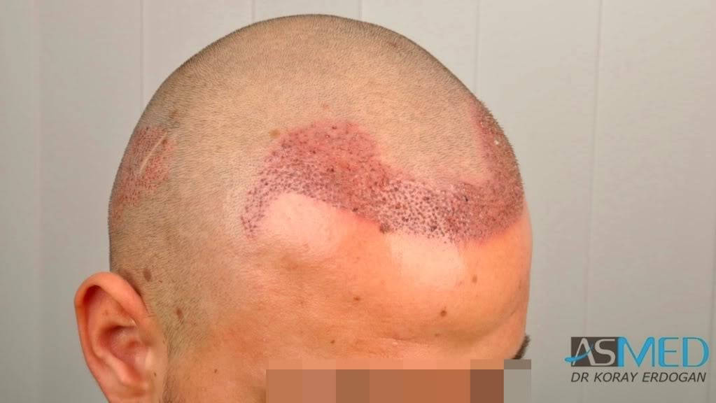 Before and After  graft    transplant at 