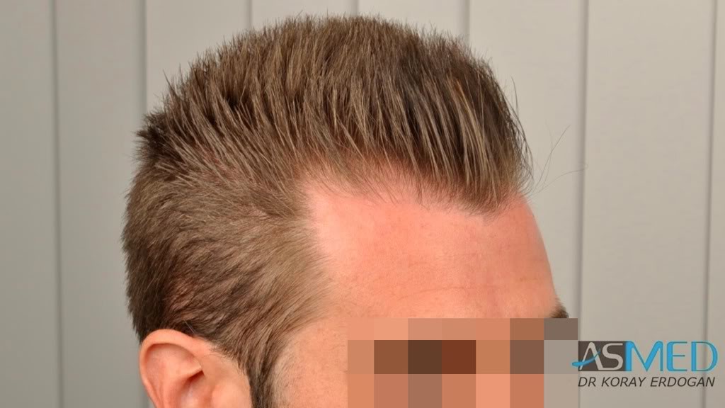 Before and After  graft    transplant at 