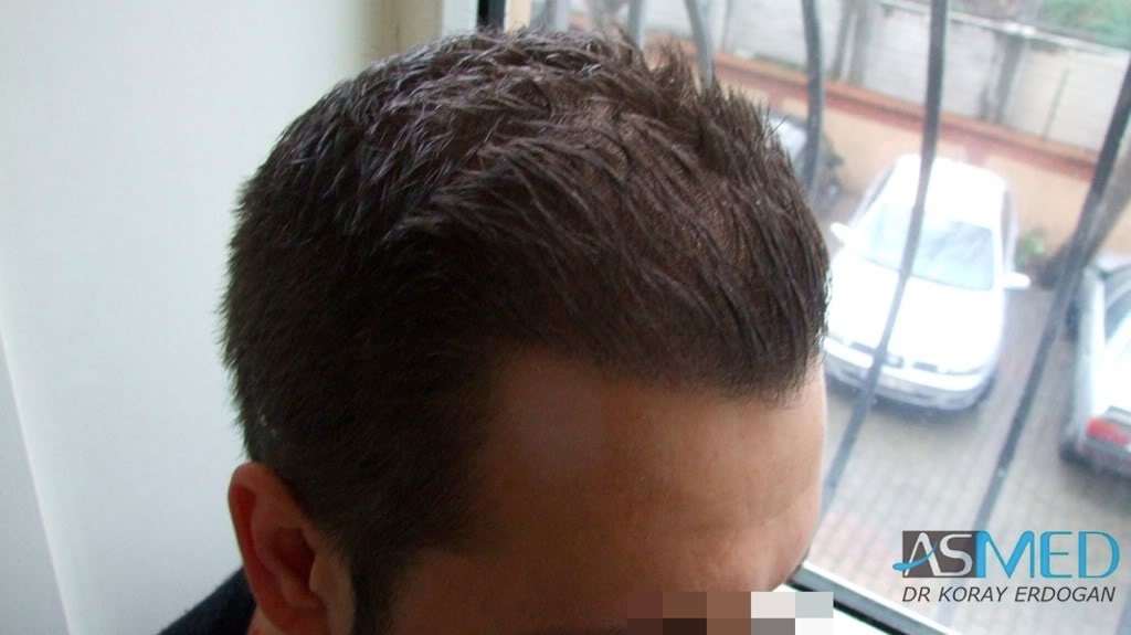 FUE Hair Transplant Result