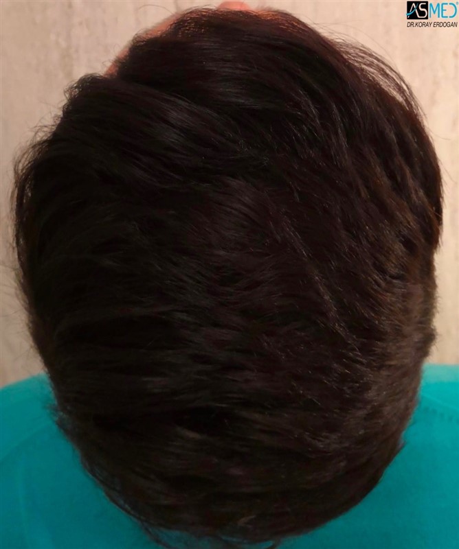 Before and After  graft    transplant at 