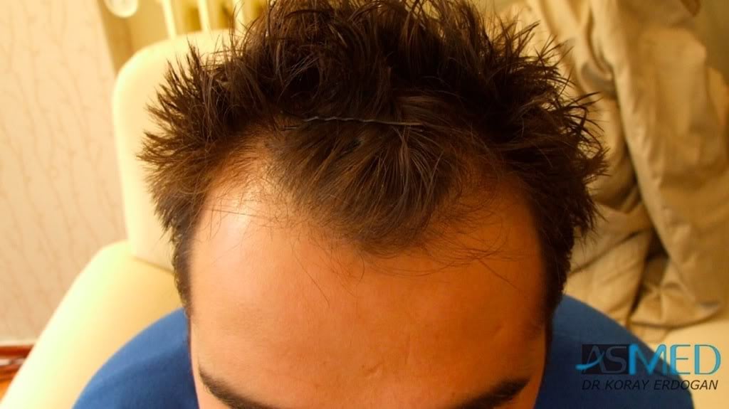 Before and After  graft    transplant at 