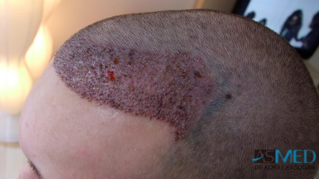Before and After  graft    transplant at 