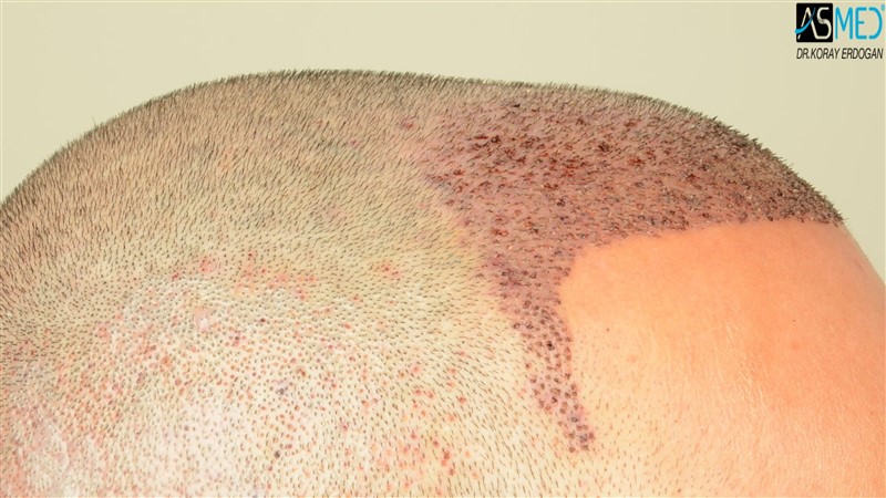 Before and After  graft    transplant at 